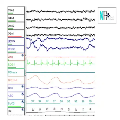 polysomnography