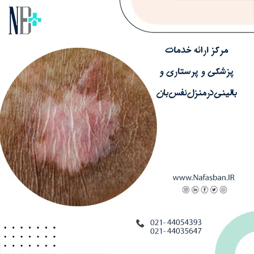 درمان زخم بستر در خانه