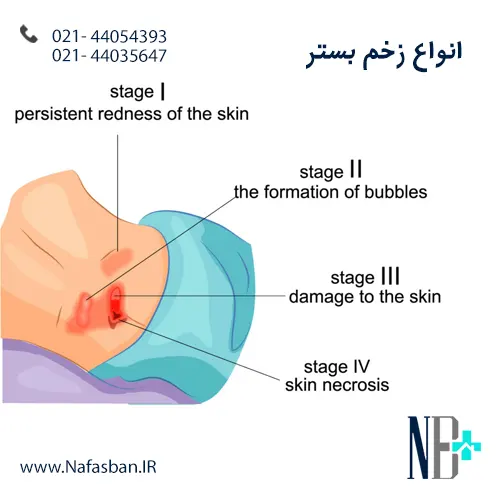 پانسمان زخم بستر در منزل