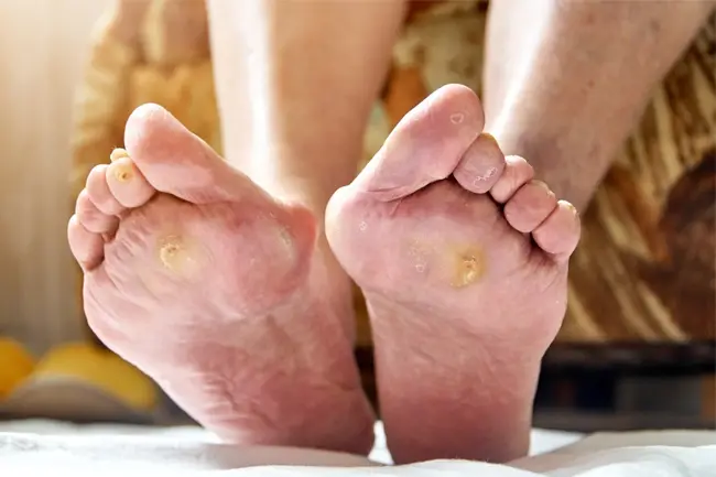 Diabetic ulcer treatment at home