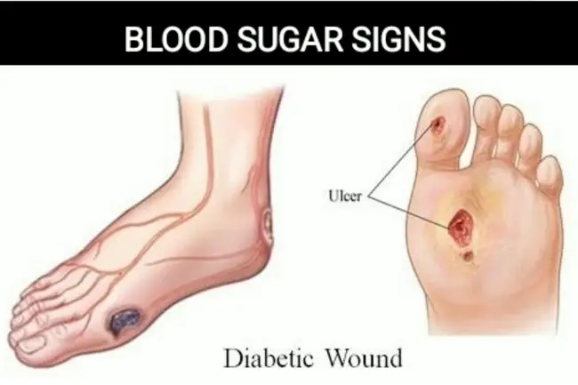 Diabetic ulcer treatment at home1