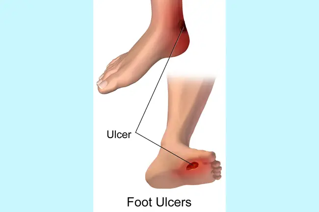 Diabetic ulcer treatment at home2