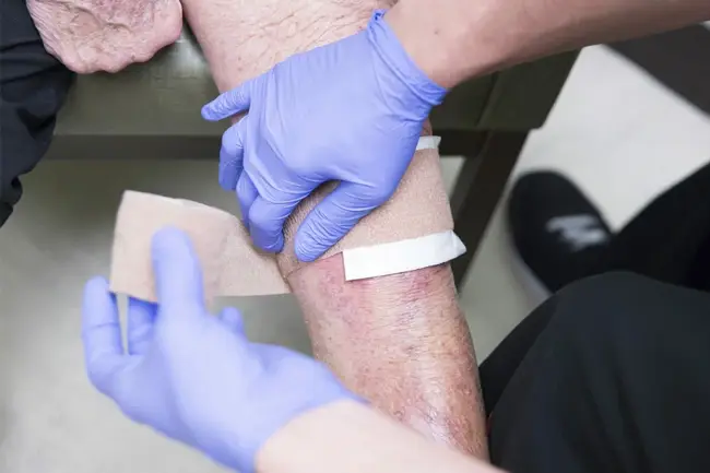Treatment of bedsores1