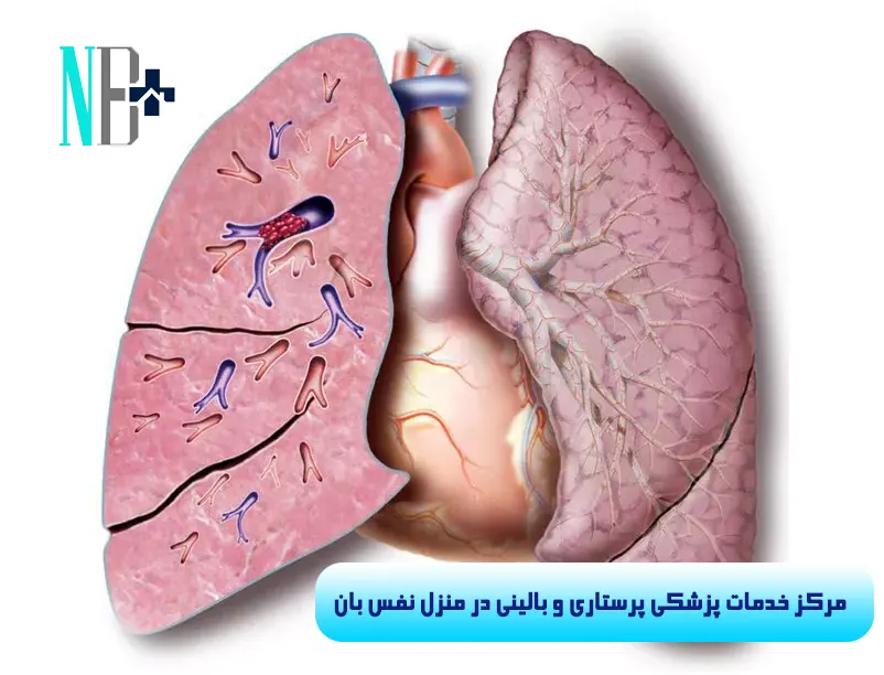 آمبولی ریه چیست و چگونه درمان میشود 1