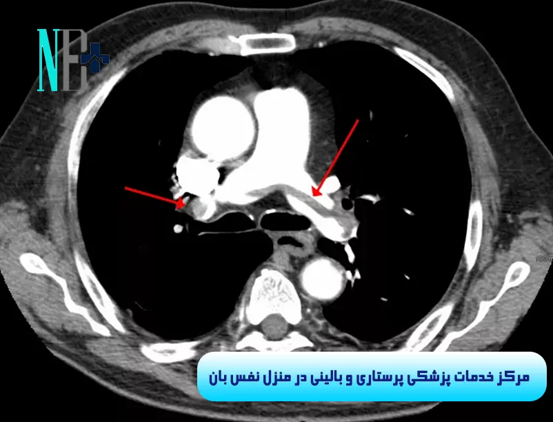 آمبولی ریه چیست و چگونه درمان میشود 7