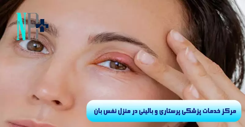 درمان عفونت چشم در منزل 1