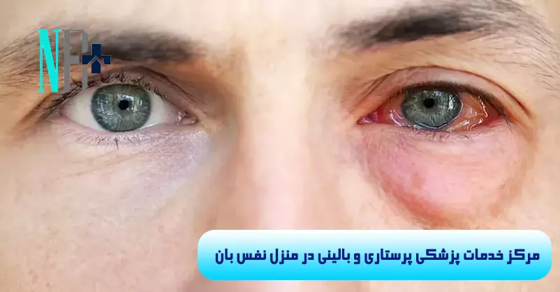 درمان عفونت چشم در منزل 7