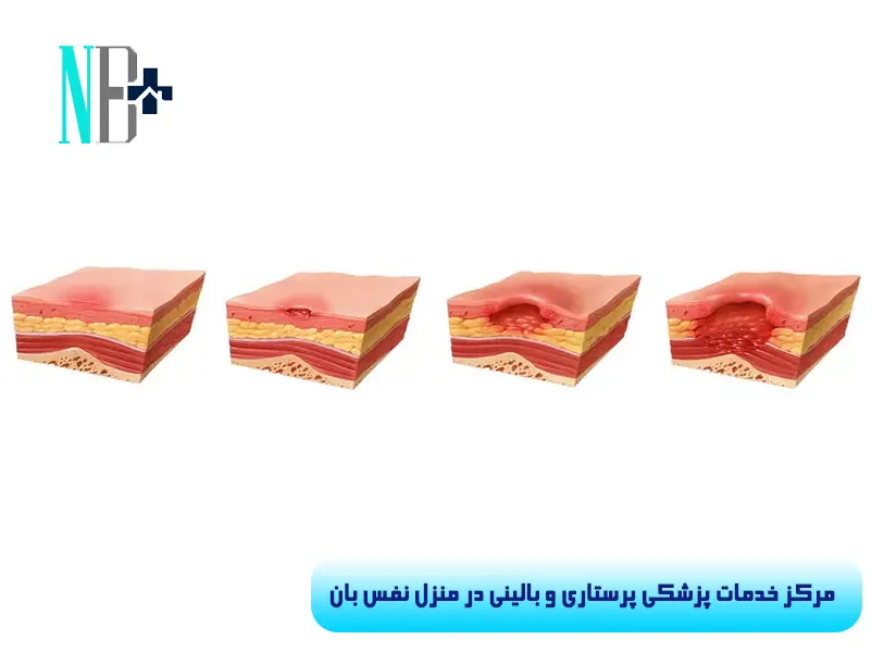 پماد زخم بستر 11