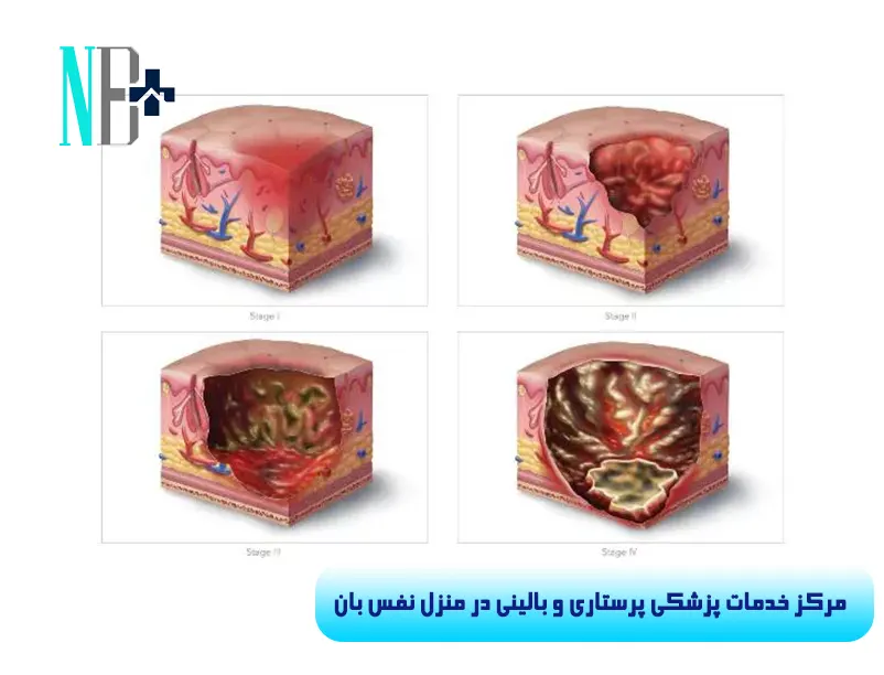 پماد زخم بستر 3